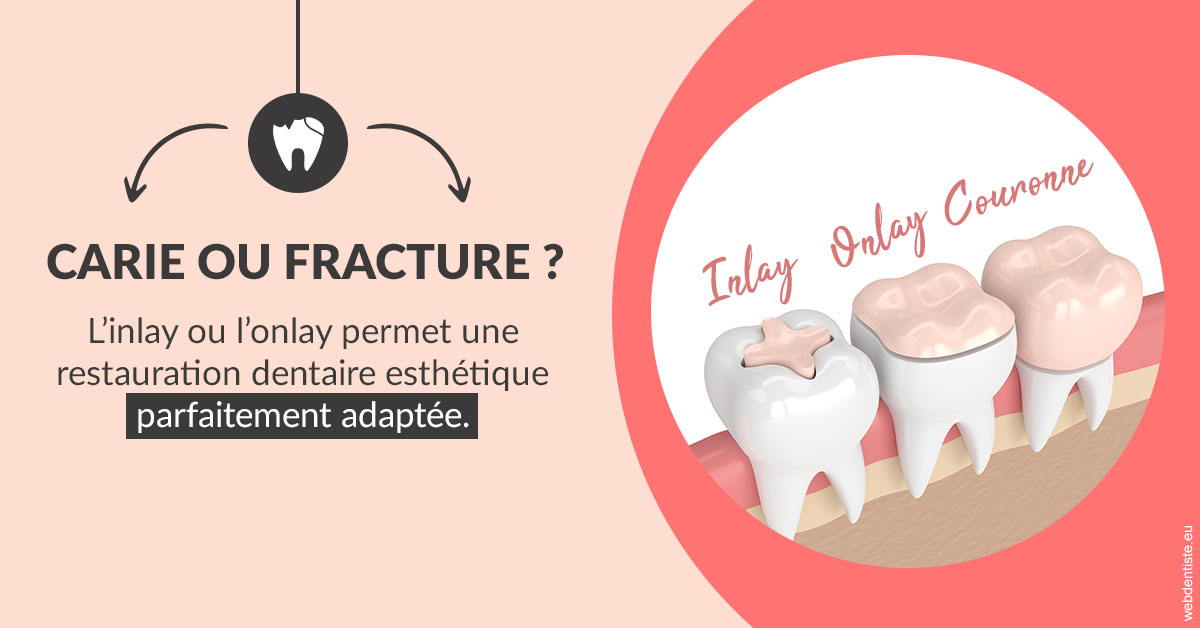 https://dr-arnaud-lecauchois.chirurgiens-dentistes.fr/T2 2023 - Carie ou fracture 2
