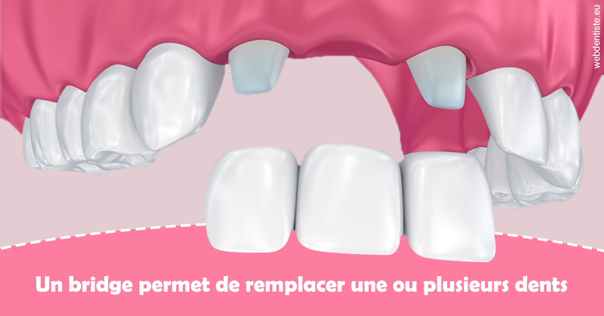 https://dr-arnaud-lecauchois.chirurgiens-dentistes.fr/Bridge remplacer dents 2