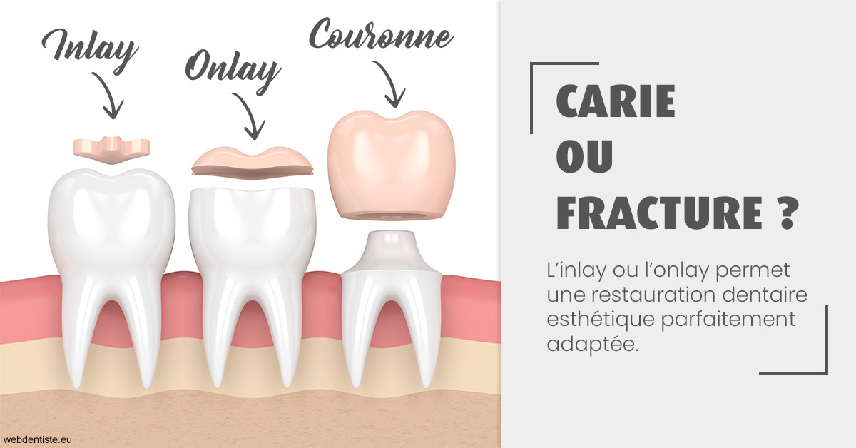 https://dr-arnaud-lecauchois.chirurgiens-dentistes.fr/T2 2023 - Carie ou fracture 1
