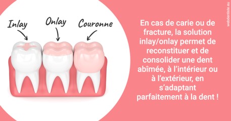 https://dr-arnaud-lecauchois.chirurgiens-dentistes.fr/L'INLAY ou l'ONLAY 2