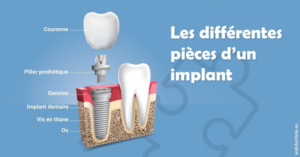 https://dr-arnaud-lecauchois.chirurgiens-dentistes.fr/Les différentes pièces d’un implant 1