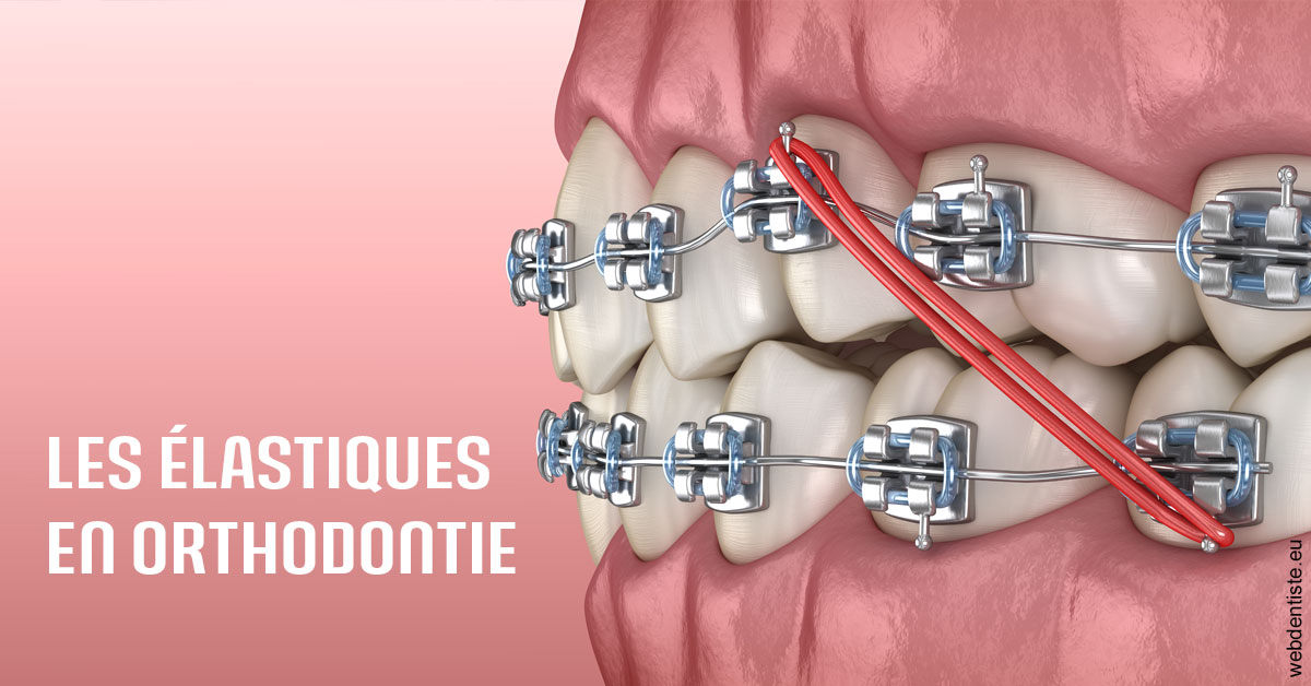 https://dr-arnaud-lecauchois.chirurgiens-dentistes.fr/Elastiques orthodontie 2